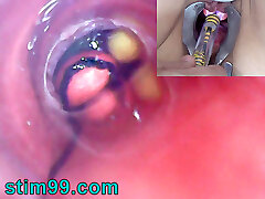Mature Woman, Peehole Endoscope Camera in Bladder with Ball-sac