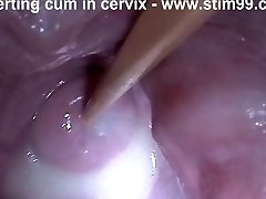 Insertion Semen Jizm in Cervix Wide Opening Up Pussy Speculum