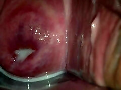 cervix