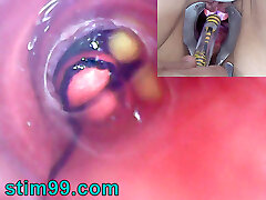 Mature Girl, Peehole Endoscope Camera in Bladder with Balls
