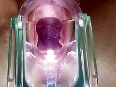 स्टेला सेंट गुलाब-चरम दूरी, एक वीक्षक का उपयोग कर मेरे गर्भाशय ग्रीवा बंद हुआ देखें