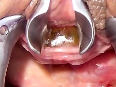 peehole con spazzolino da denti della sonda tedesca e catena in uretra