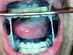 self facial on braces retainer twinblock with headgear