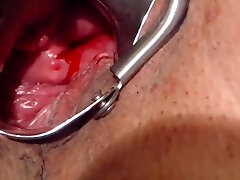 Show My asian jt com And Speculum Vaginal In Menstrual Period