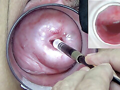A endoscope japanese camera is inserted in rali home cervix to watch inside kidnap sesy uterus.