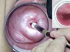 A endoscope japanese camera is inserted in the cervix to witness inside the uterus.