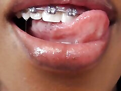 Black girl teeth brace fetish!